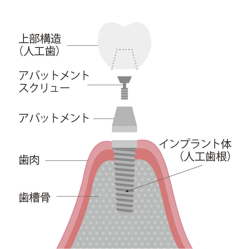 セメント固定を行う場合