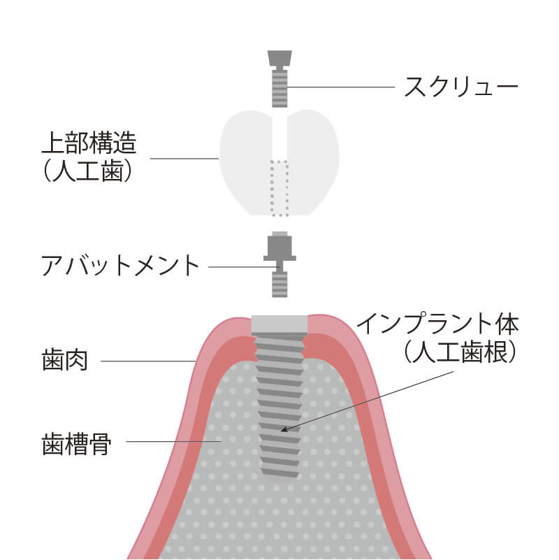 スクリュー固定のメリット