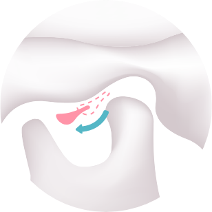 顎関節内部の異常