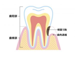 歯根う歯