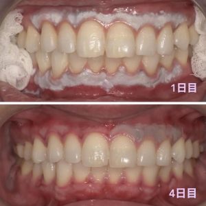 ガムピーリング施術後1日目と4日目